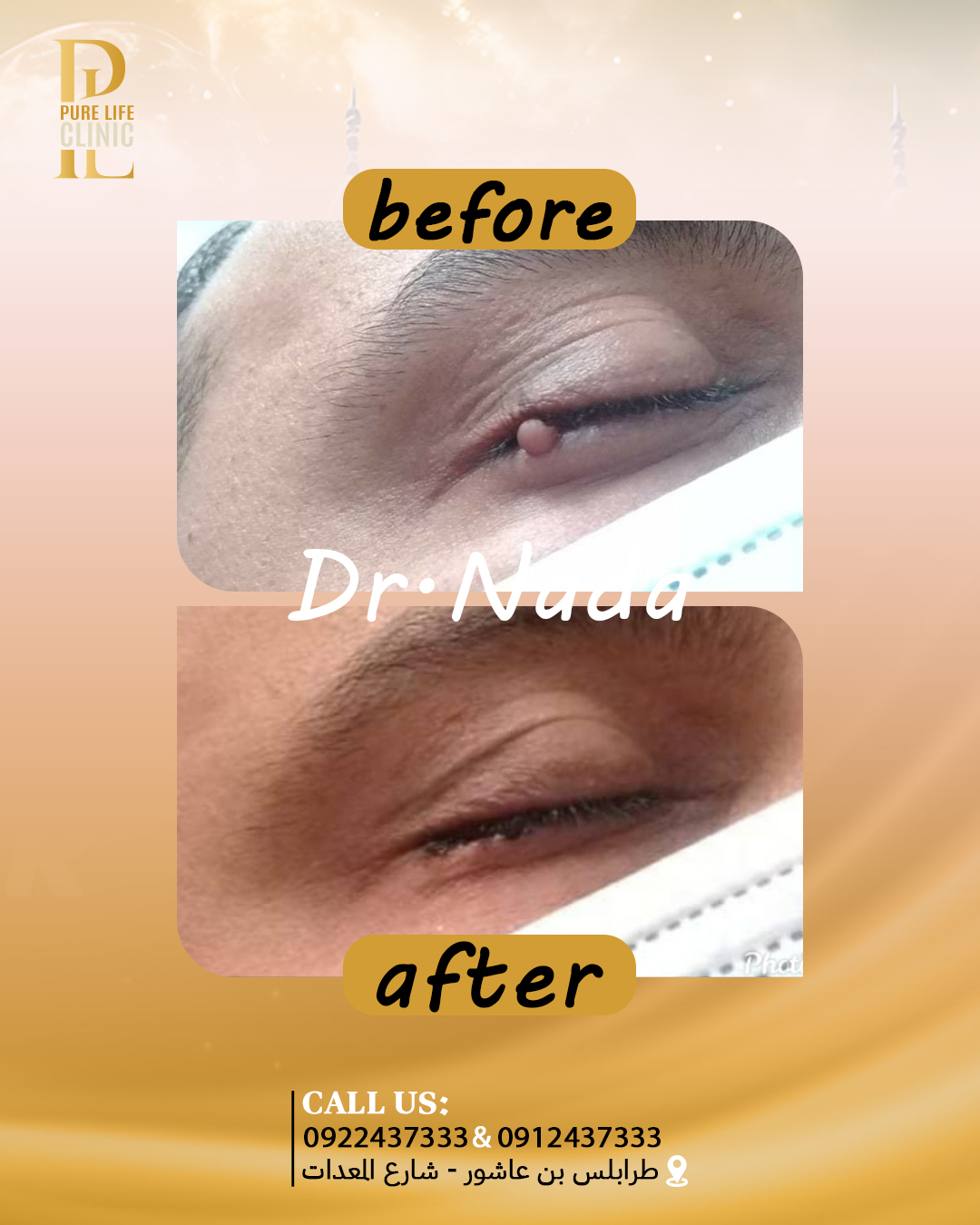 ازالة الزوائد الجلدية (جراحي وغير جراحي)